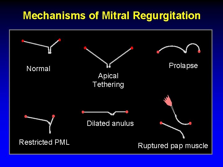 Mechanisms of Mitral Regurgitation Normal Prolapse Apical Tethering Dilated anulus Restricted PML Ruptured pap