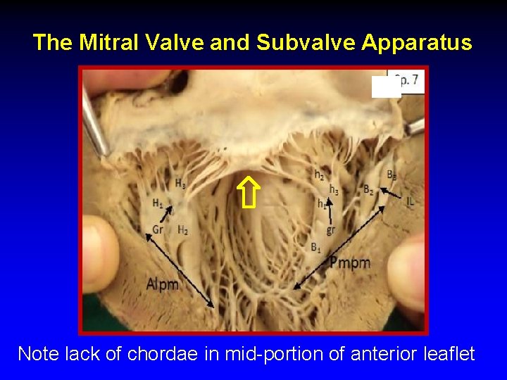 The Mitral Valve and Subvalve Apparatus Note lack of chordae in mid-portion of anterior