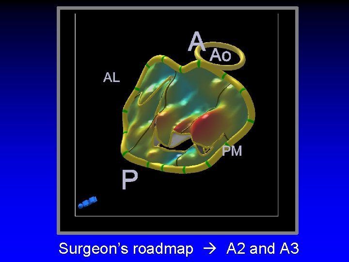 Surgeon’s roadmap A 2 and A 3 