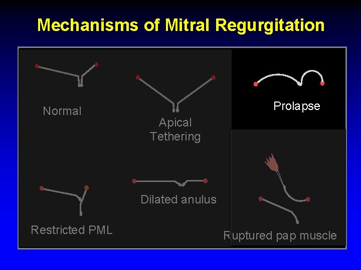 Mechanisms of Mitral Regurgitation Normal Prolapse Apical Tethering Dilated anulus Restricted PML Ruptured pap