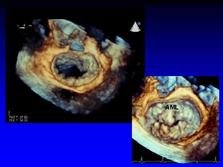 AML 