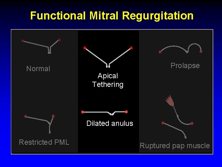 Functional Mitral Regurgitation Normal Prolapse Apical Tethering Dilated anulus Restricted PML Ruptured pap muscle