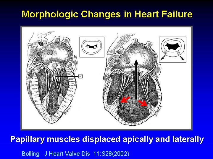 Morphologic Changes in Heart Failure Papillary muscles displaced apically and laterally Bolling J Heart