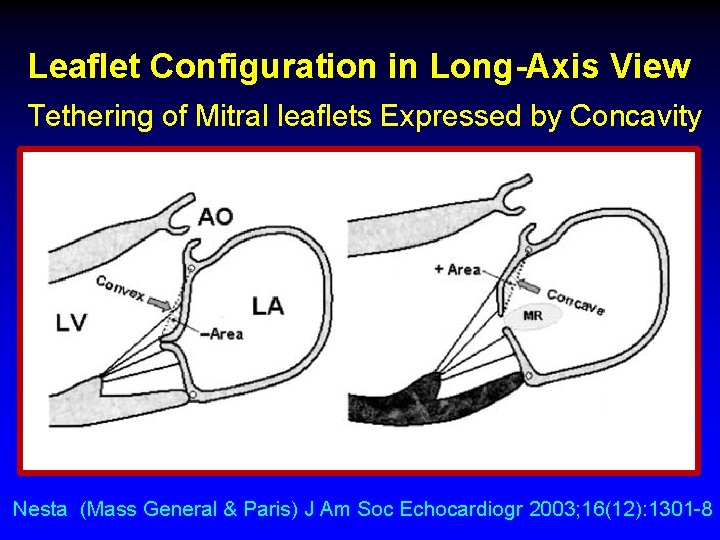 Leaflet Configuration in Long-Axis View Tethering of Mitral leaflets Expressed by Concavity Nesta (Mass