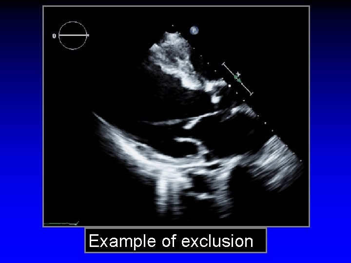 Example of exclusion 