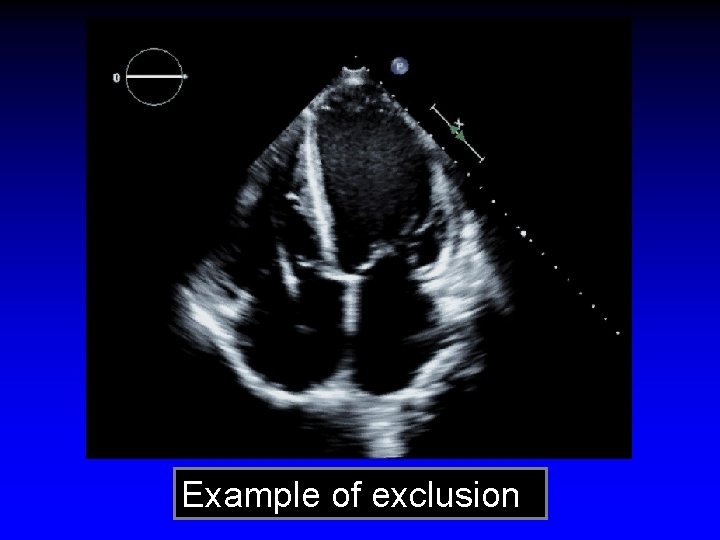 Example of exclusion 