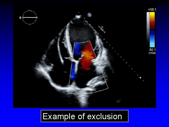 Example of exclusion 