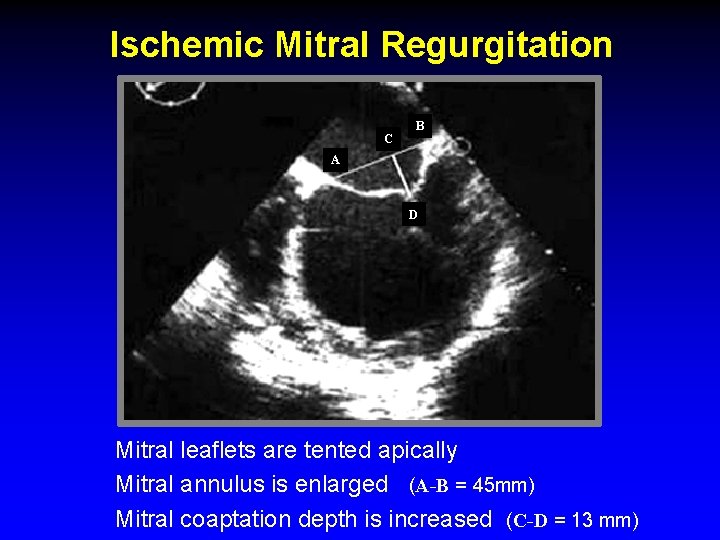 Ischemic Mitral Regurgitation C B A D Mitral leaflets are tented apically Mitral annulus