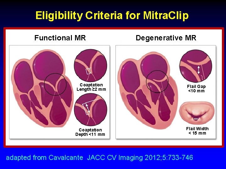 Eligibility Criteria for Mitra. Clip Functional MR Degenerative MR Coaptation Length ≥ 2 mm