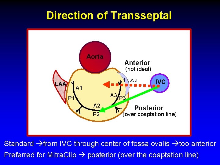 Direction of Transseptal Aorta Anterior (not ideal) Fossa LAA A 1 IVC A 3