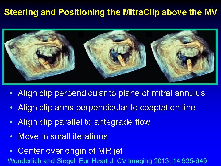 Steering and Positioning the Mitra. Clip above the MV • Align clip perpendicular to