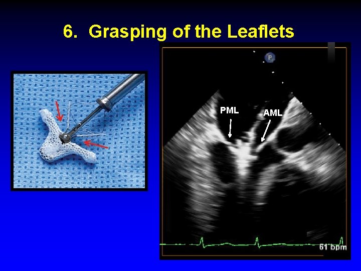 6. Grasping of the Leaflets PML AML 