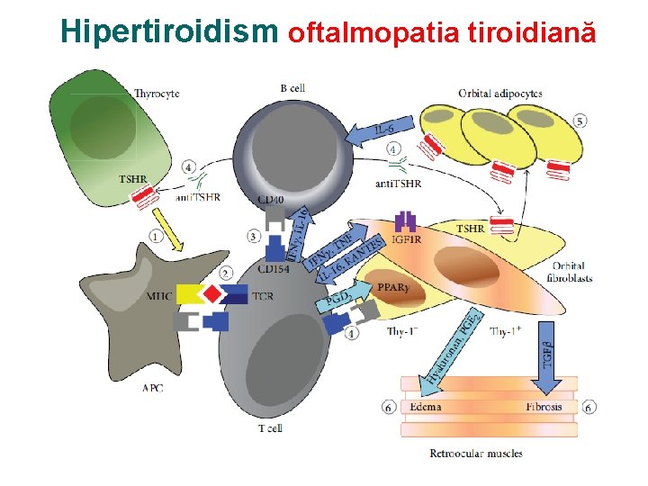 Hipertiroidism oftalmopatia tiroidiană 