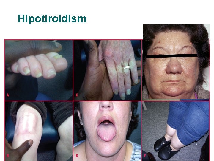 Hipotiroidism 