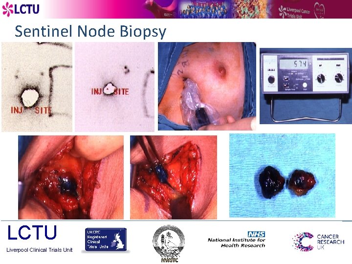 Sentinel Node Biopsy LCTU Liverpool Clinical Trials Unit 