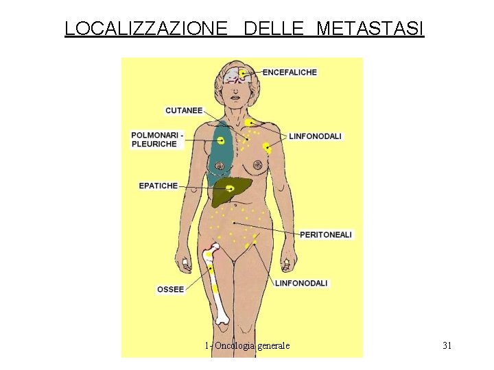 LOCALIZZAZIONE DELLE METASTASI 1 - Oncologia generale 31 