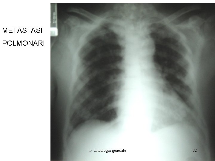 METASTASI POLMONARI 1 - Oncologia generale 32 