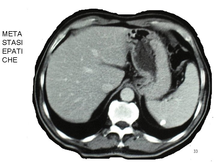 META STASI EPATI CHE 1 - Oncologia generale 33 