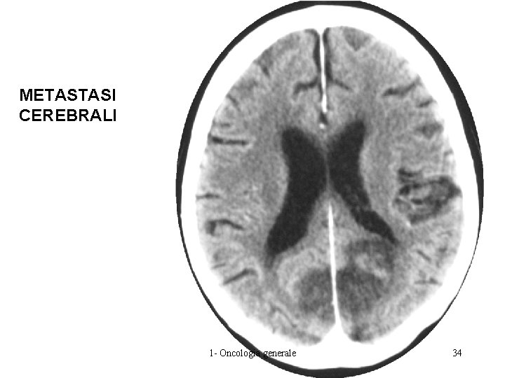 METASTASI CEREBRALI 1 - Oncologia generale 34 