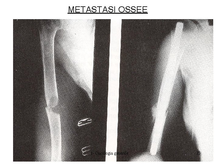 METASTASI OSSEE 1 - Oncologia generale 35 