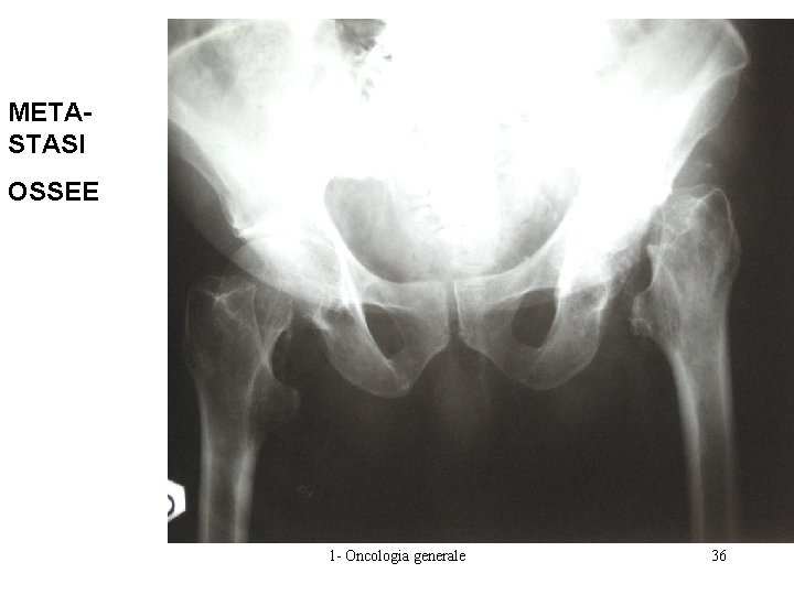 METASTASI OSSEE 1 - Oncologia generale 36 