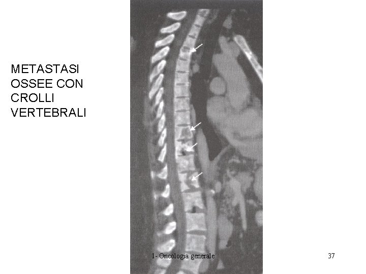 METASTASI OSSEE CON CROLLI VERTEBRALI 1 - Oncologia generale 37 