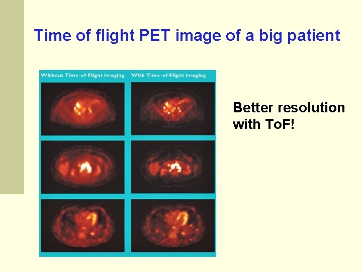 Time of flight PET image of a big patient Better resolution with To. F!