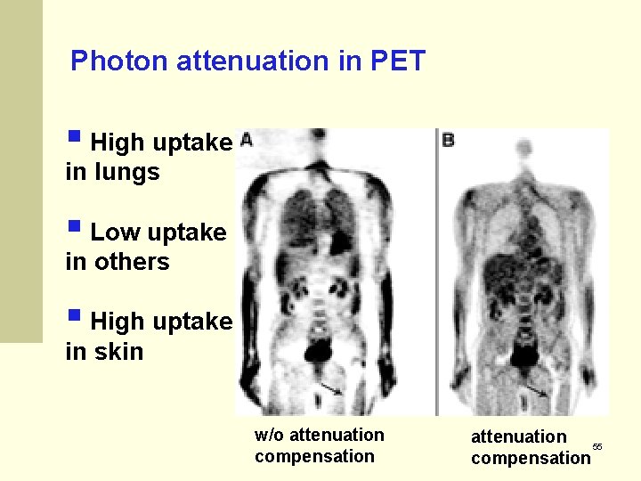 Photon attenuation in PET § High uptake in lungs § Low uptake in others