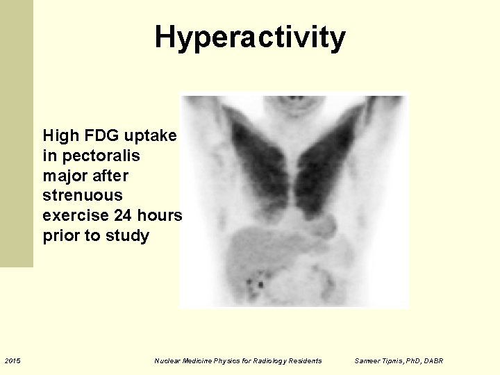 Hyperactivity High FDG uptake in pectoralis major after strenuous exercise 24 hours prior to