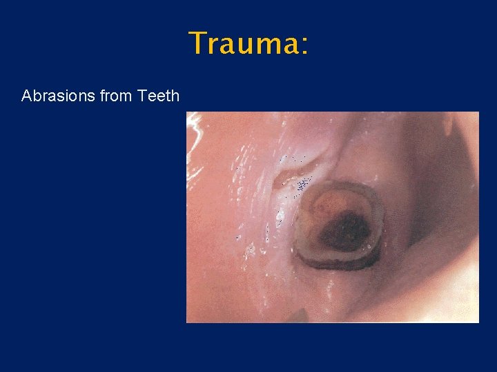 Trauma: Abrasions from Teeth 