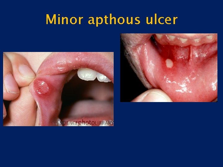 Minor apthous ulcer 