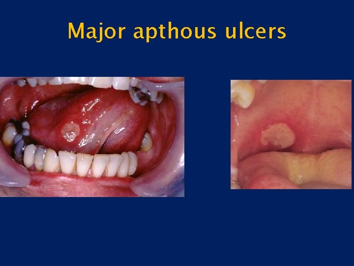 Major apthous ulcers 