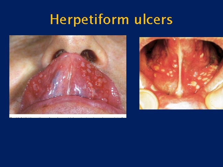 Herpetiform ulcers 