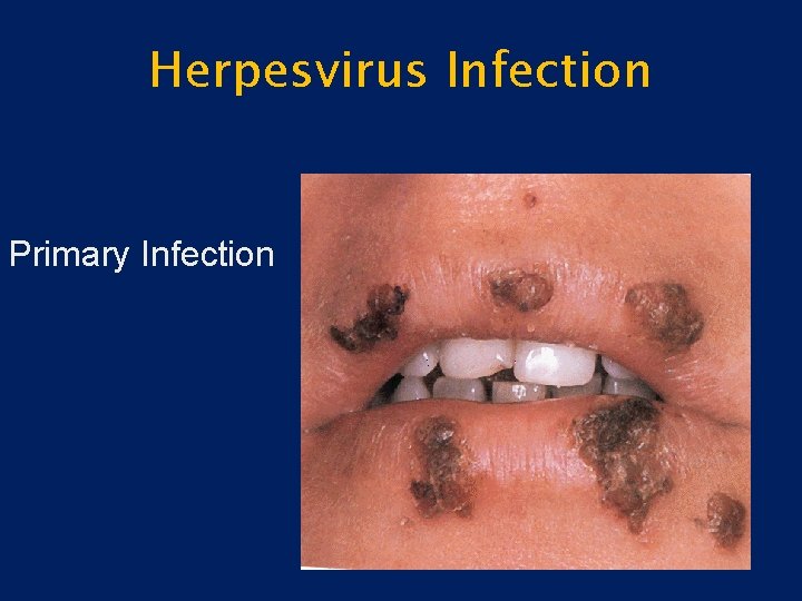 Herpesvirus Infection Primary Infection 