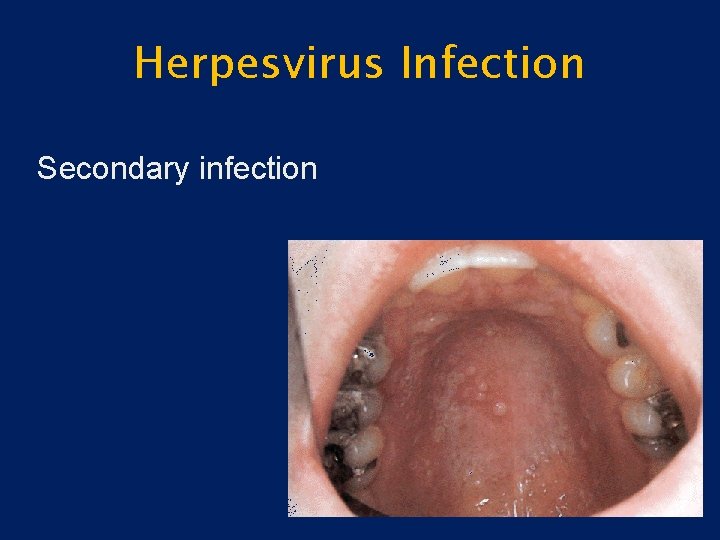 Herpesvirus Infection Secondary infection 