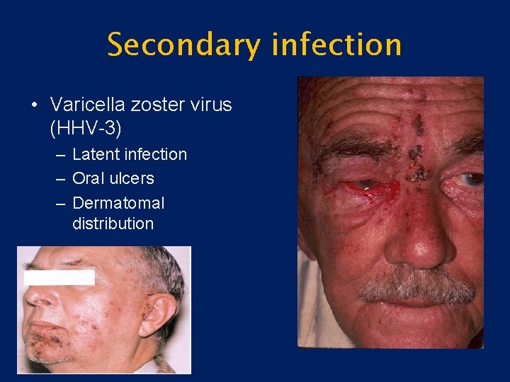 Secondary infection • Varicella zoster virus (HHV-3) – Latent infection – Oral ulcers –