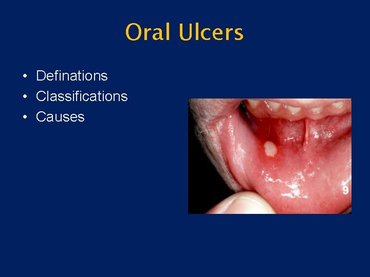 Oral Ulcers • Definations • Classifications • Causes 
