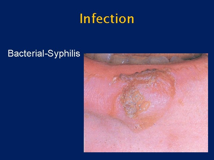 Infection Bacterial-Syphilis 