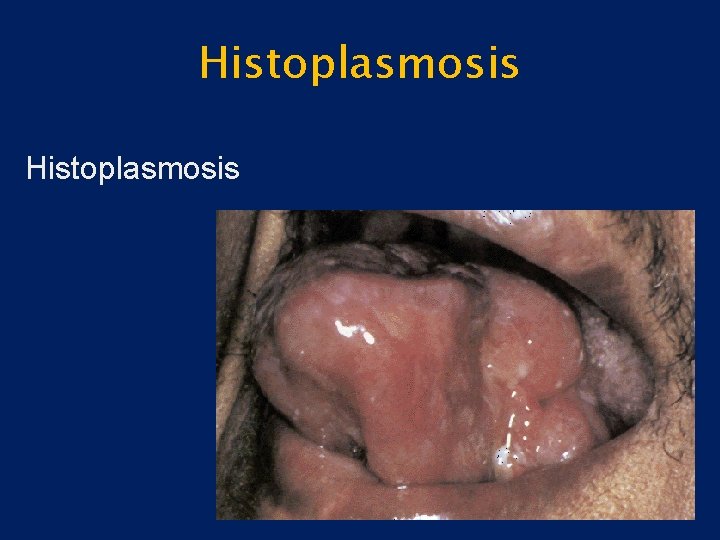 Histoplasmosis 