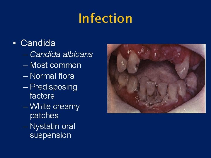 Infection • Candida – Candida albicans – Most common – Normal flora – Predisposing