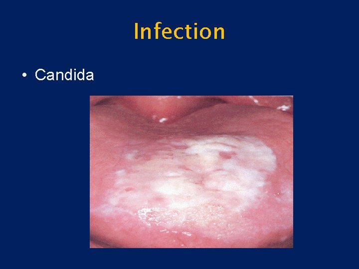 Infection • Candida 