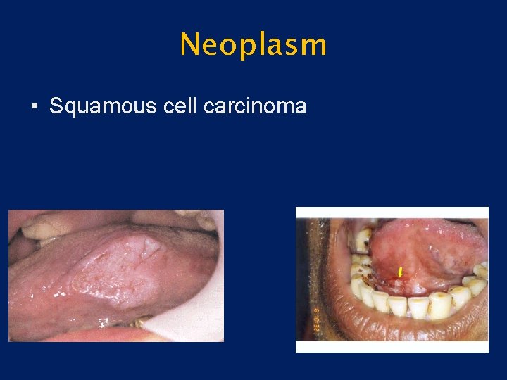 Neoplasm • Squamous cell carcinoma 