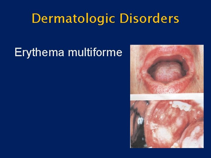 Dermatologic Disorders Erythema multiforme 