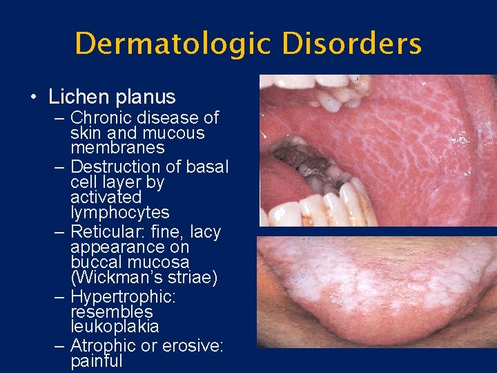 Dermatologic Disorders • Lichen planus – Chronic disease of skin and mucous membranes –