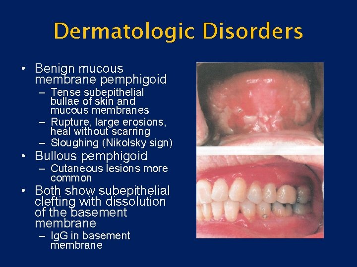 Dermatologic Disorders • Benign mucous membrane pemphigoid – Tense subepithelial bullae of skin and