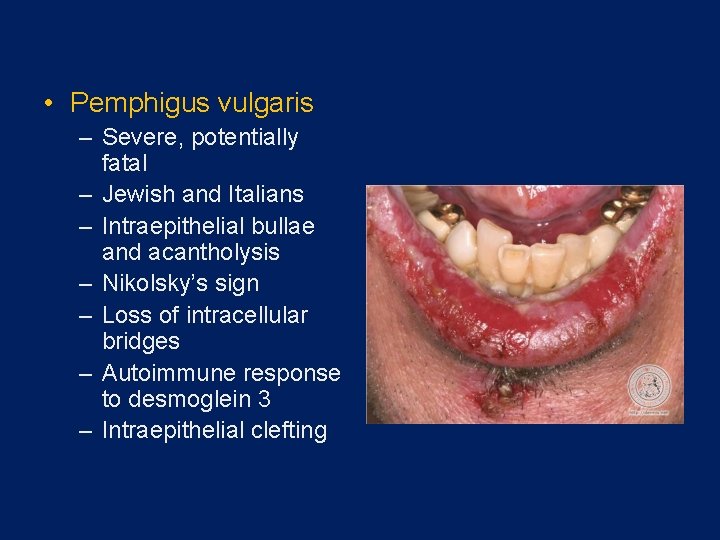  • Pemphigus vulgaris – Severe, potentially fatal – Jewish and Italians – Intraepithelial