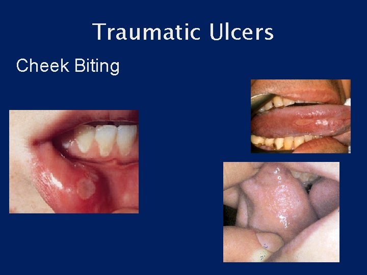Traumatic Ulcers Cheek Biting 
