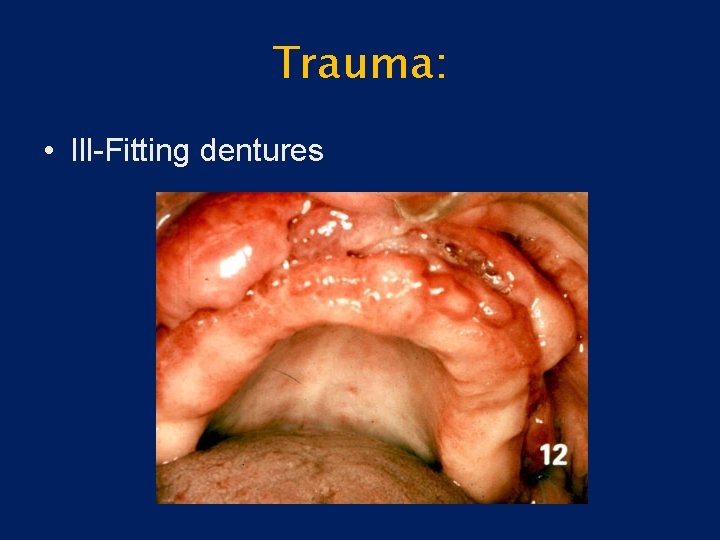 Trauma: • Ill-Fitting dentures 