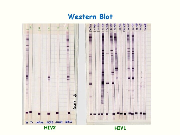 Western Blot HIV 2 HIV 1 