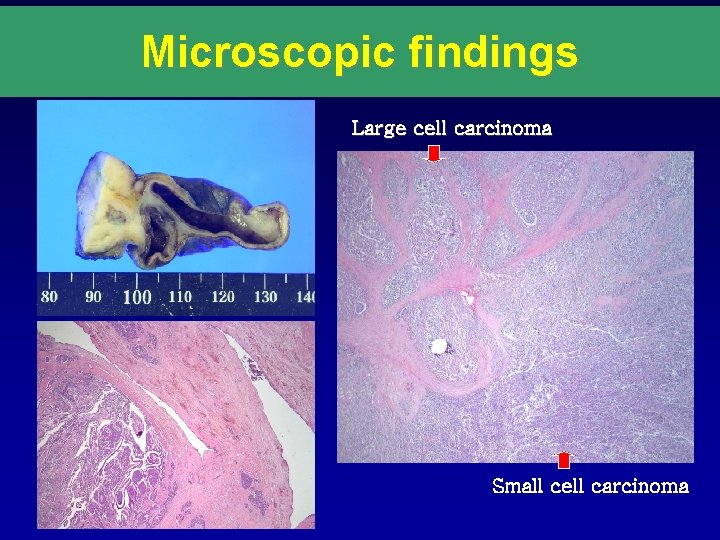 Microscopic findings Large cell carcinoma Small cell carcinoma 